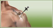 Shoulder - Daniel F Craviotto Jr MD - Orthopaedic Surgery